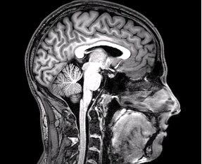 Coupe sagittale d'un cerveau humain en IRM